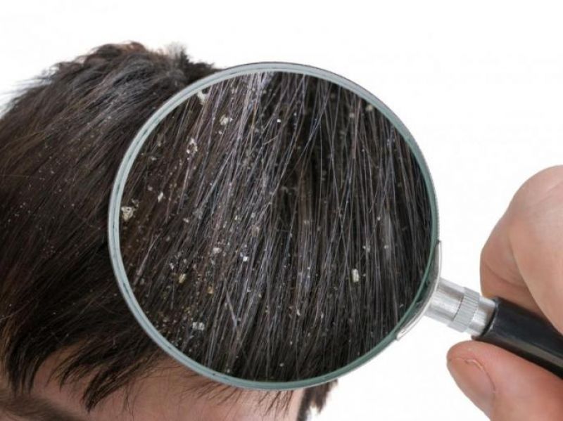 Dandruff treatment household tips Dandruff treatment household tips