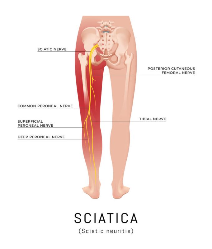Sciatica Pain 