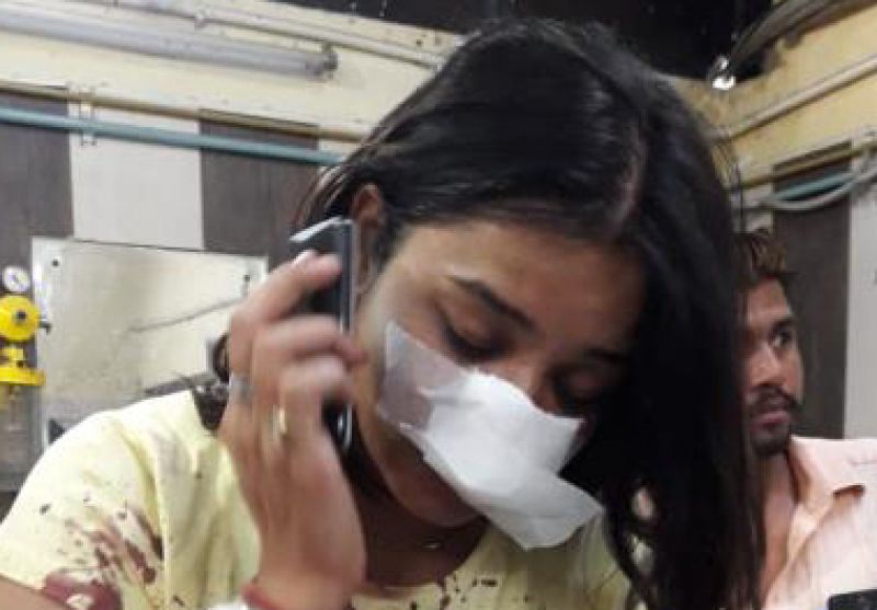 Doctor bites on wife's nose over domestic dispute