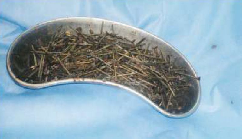 116 Iron Nails, Wire Removed From Man's Stomach In Rajathan's Bundi