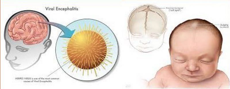 Encephalitis 
