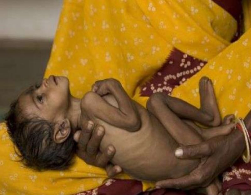 Malnutrition in Bihar